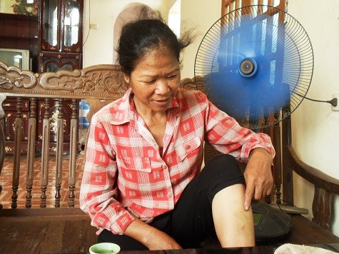 Bà Nguyễn Thị Luân chỉ cho chúng tôi xem vết thương bị chó cắn.